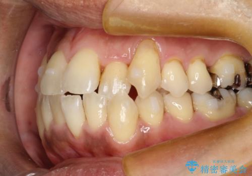 前歯のガタガタ 反対咬合を短期間に改善　インビザライン治療の治療中