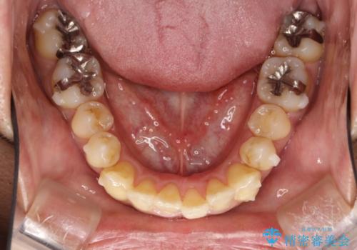 前歯のガタガタ 反対咬合を短期間に改善　インビザライン治療の治療中