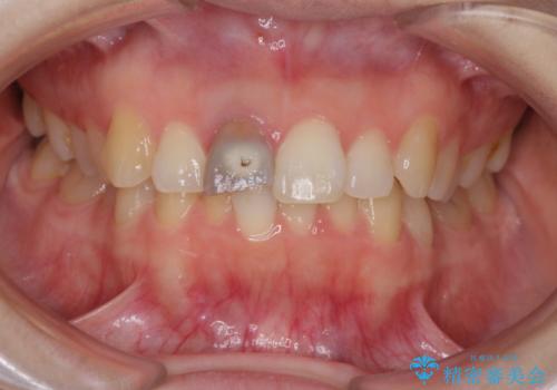 前歯に穴が空いた　根管治療とオールセラミッククラウンの治療前