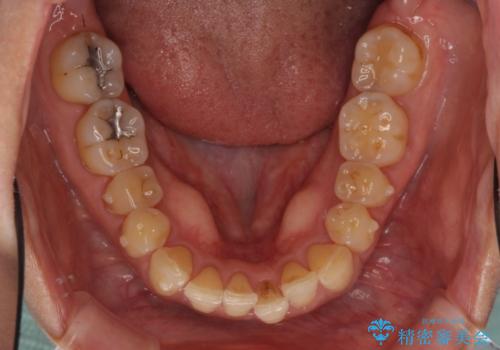 前歯のでこぼこをきれいに　インビザラインによる矯正治療の治療中