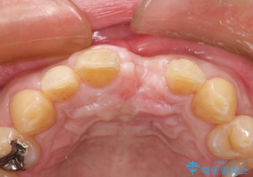 上の前歯が割れた　インプラントによる審美的・機能的回復の治療中