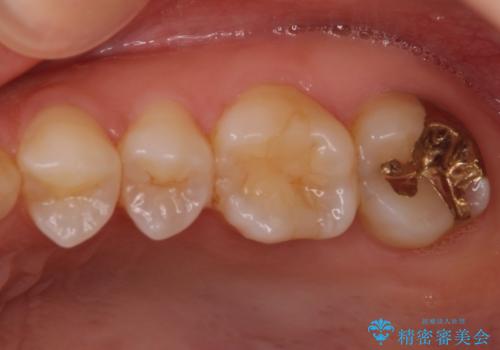 奥歯の審美的なむし歯治療　の治療後
