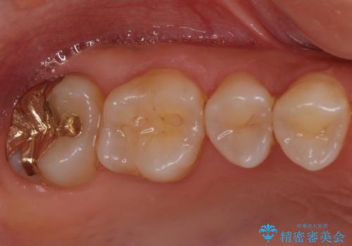 奥歯の審美的なむし歯治療　の治療後