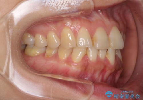 前歯のでこぼこをきれいに　インビザラインによる矯正治療の治療前