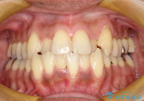 前歯のガタガタ 反対咬合を短期間に改善　インビザライン治療の治療前