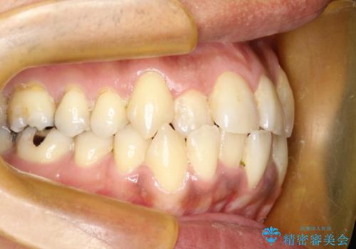 前歯のガタガタ 反対咬合を短期間に改善　インビザライン治療の治療前