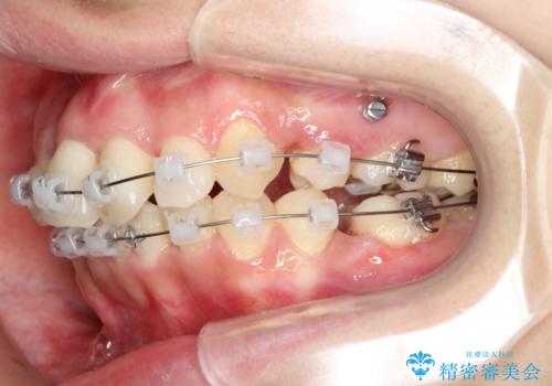 重度の前歯のガタガタの矯正治療の治療中