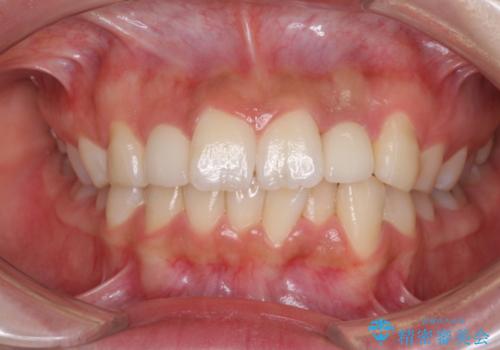 変色した前歯をオールセラミッククラウンで自然な色にの治療後