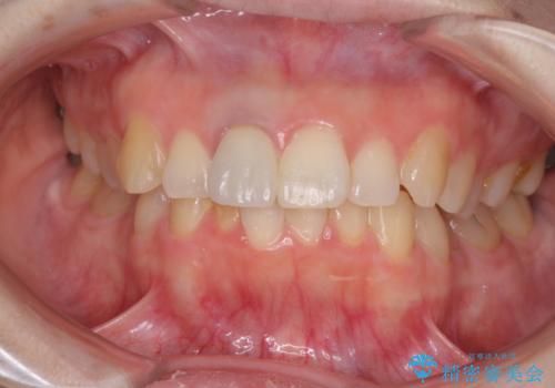 前歯に穴が空いた　根管治療とオールセラミッククラウンの治療後