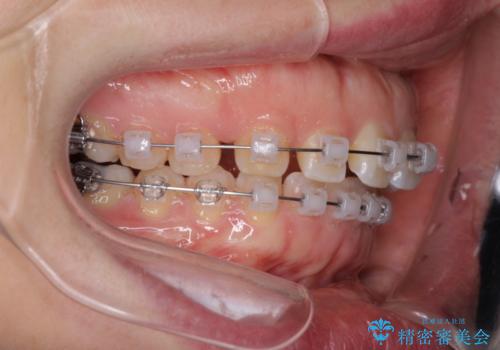 すきっ歯のワイヤー矯正による治療の治療中