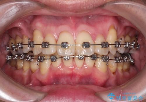 八重歯のワイヤー矯正　古典的なメタルの装置の一例の治療中