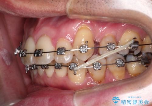 八重歯のワイヤー矯正　古典的なメタルの装置の一例の治療中
