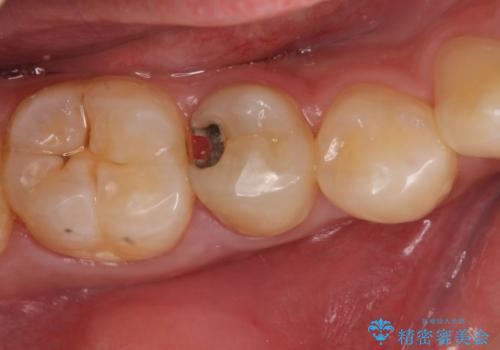 虫歯による大きな欠損　セラミックインレー修復の治療前