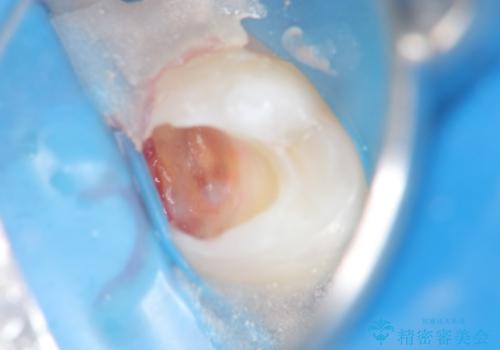 虫歯による大きな欠損　セラミックインレー修復の治療中