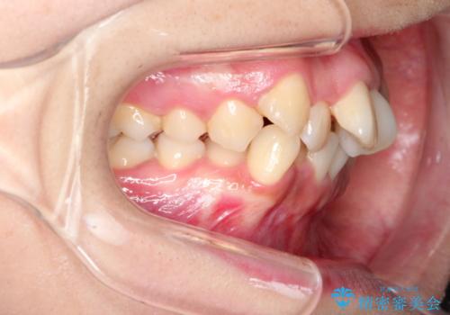重度の前歯のガタガタの矯正治療の治療前
