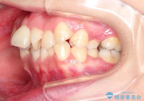 重度の前歯のガタガタの矯正治療の治療前