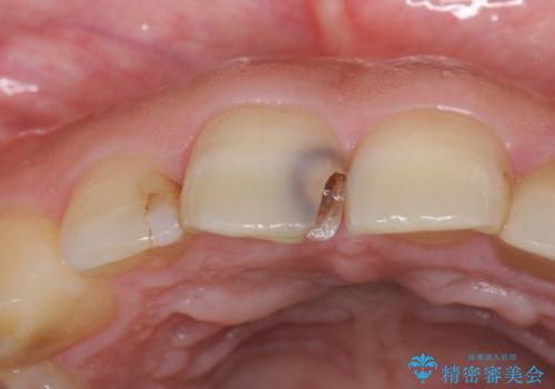 前歯の大きい虫歯の治療前