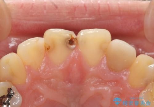 前歯の大きい虫歯の治療前
