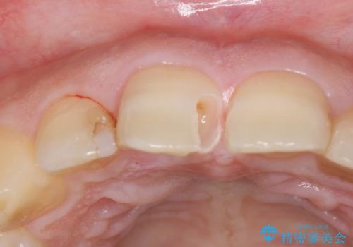 前歯の大きい虫歯の治療中