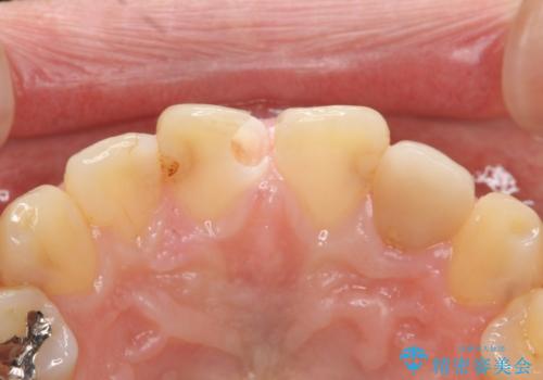 前歯の大きい虫歯の治療中