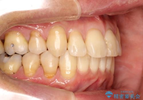 八重歯のワイヤー矯正　古典的なメタルの装置の一例の治療後