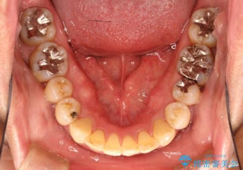 八重歯のワイヤー矯正　古典的なメタルの装置の一例の治療後