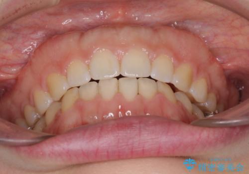 すきっ歯のワイヤー矯正による治療の治療後