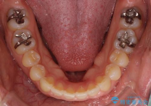 すきっ歯のワイヤー矯正による治療の治療後