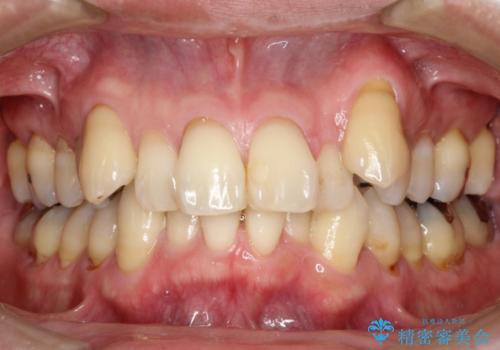 八重歯のワイヤー矯正　古典的なメタルの装置の一例の治療前