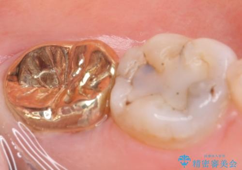 ゴールドクラウン(PGAクラウン)　隙間のない歯の補綴の治療後