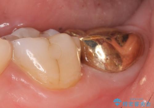ゴールドクラウン(PGAクラウン)　隙間のない歯の補綴の治療後