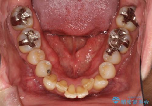 八重歯のワイヤー矯正　古典的なメタルの装置の一例の治療前