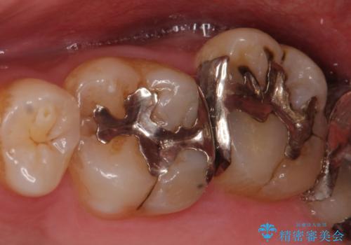 銀歯から白い歯への治療前