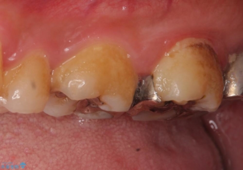 銀歯から白い歯への治療前