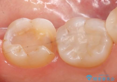 セラミックインレー　銀歯を白い歯への治療中