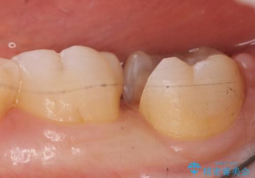 セラミックインレー　銀歯を白い歯への治療中