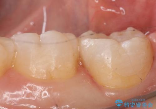 セラミックインレー　銀歯を白い歯への治療後
