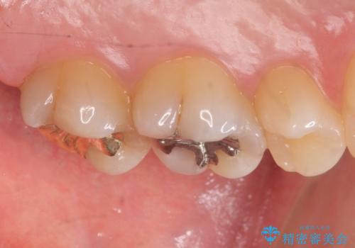 深い虫歯の治療　適合のいいゴールドインレーの治療後