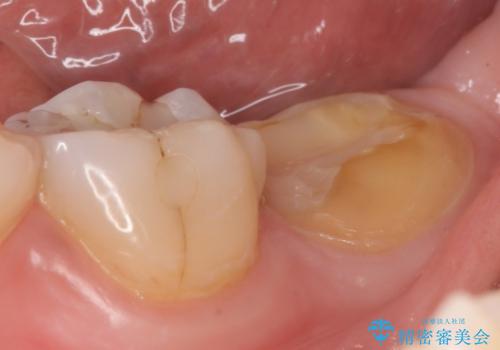 ゴールドクラウン(PGAクラウン)　隙間のない歯の補綴の治療前