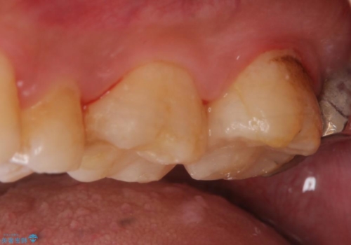 銀歯から白い歯への治療後