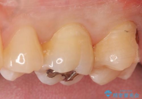 深い虫歯の治療　適合のいいゴールドインレーの治療前