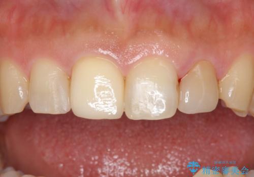 前歯の大きい虫歯の治療後
