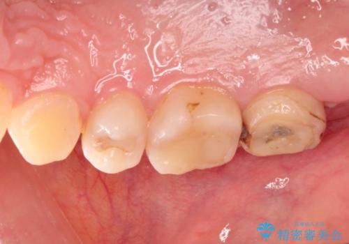 奥歯の高さが足りない　歯周外科で解決し、咬み合わせを回復するの治療前