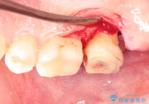 奥歯の高さが足りない　歯周外科で解決し、咬み合わせを回復するの治療中