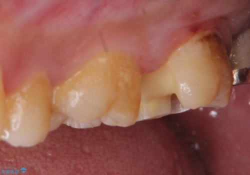 銀歯から白い歯への治療中