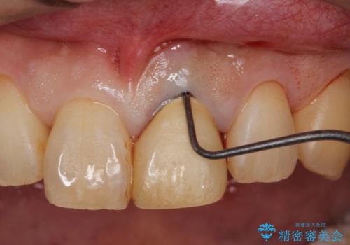 上の前歯が割れた　インプラントによる審美的・機能的回復の治療前