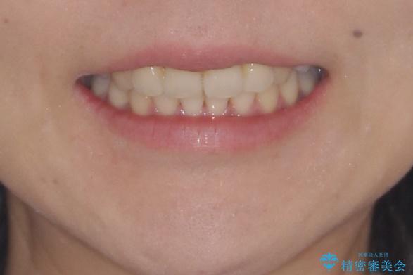 重度の前歯のガタガタの矯正治療の治療後（顔貌）