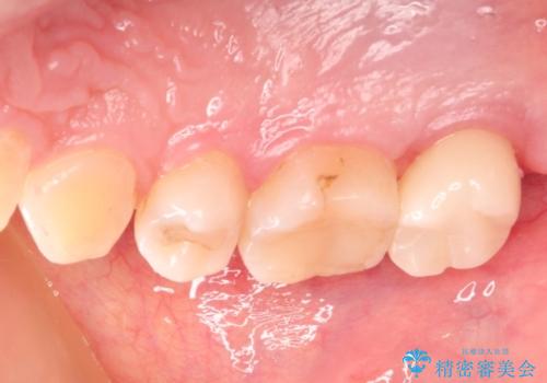 奥歯の高さが足りない　歯周外科で解決し、咬み合わせを回復するの治療後