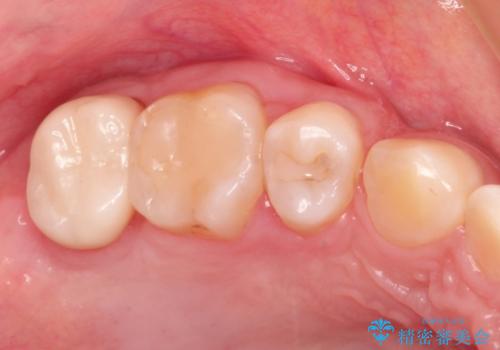 奥歯の高さが足りない　歯周外科で解決し、咬み合わせを回復するの治療後