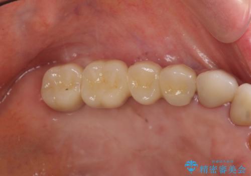 臼歯の遊離端欠損　インプラント補綴の治療後